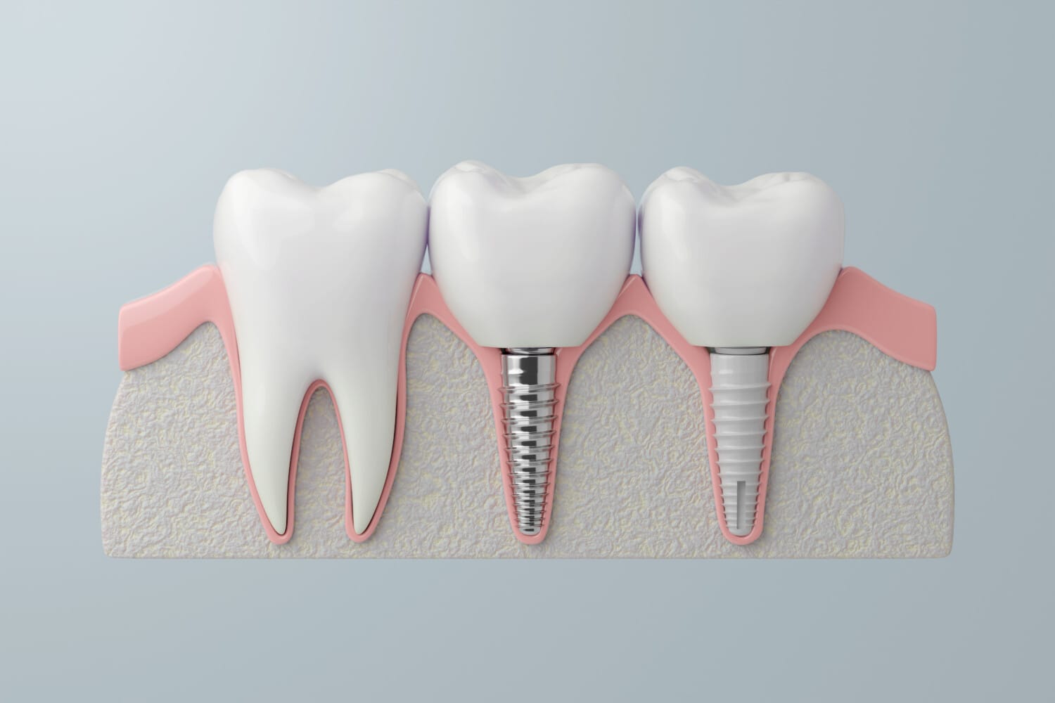 Comparison of Titanium and Zirconia Dental Implant Types. 3D Rendering Comparison of Titanium and Zirconia Dental Implant Types. 3D Rendering