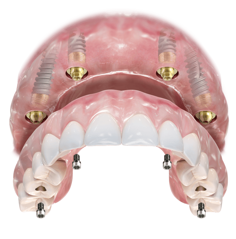 Maxilla with 4 mua Maxilla with 4 mua